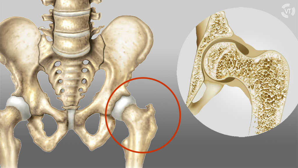 femoral neck osteoporosis