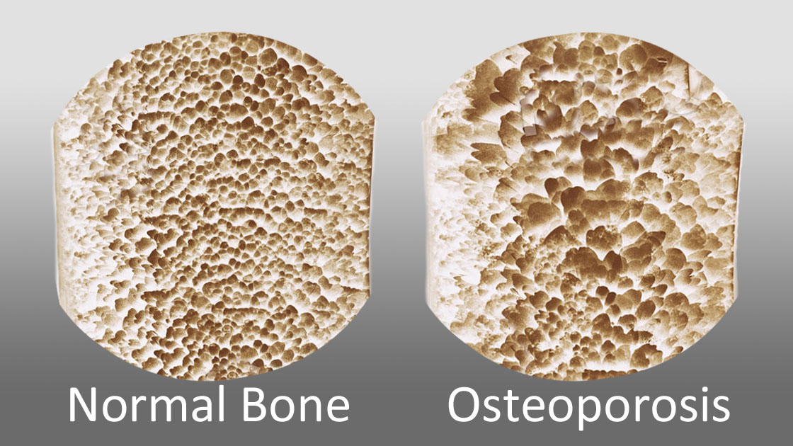 normal bone compared with osteoporosis bone